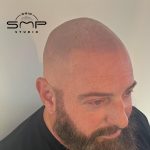 scalp micro Mahoning County Ohio