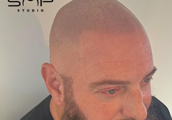 scalp micro Mahoning County Ohio