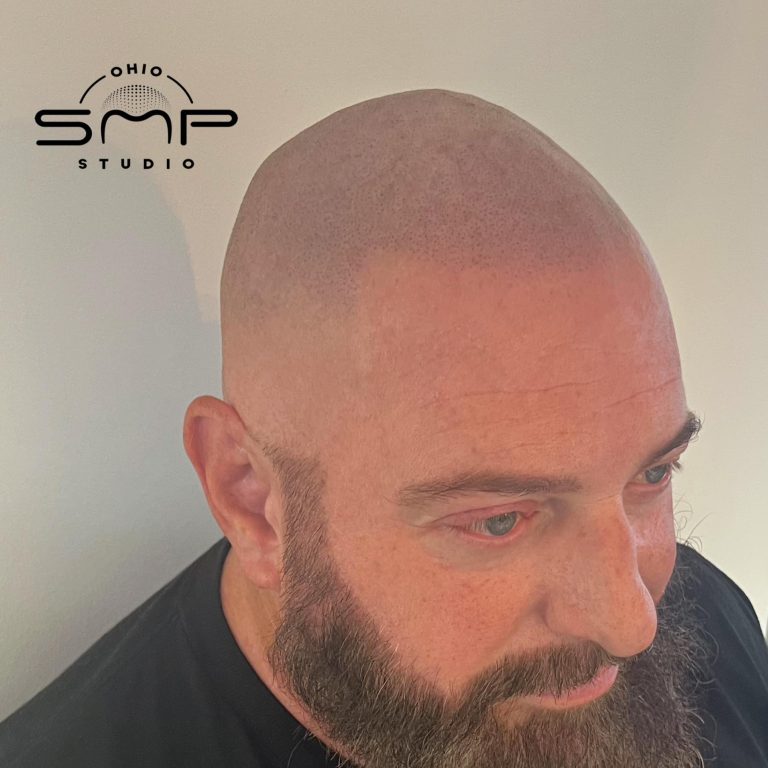 scalp micro Mahoning County Ohio